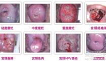 宫颈糜烂的早期症状,识别与预防的关键”